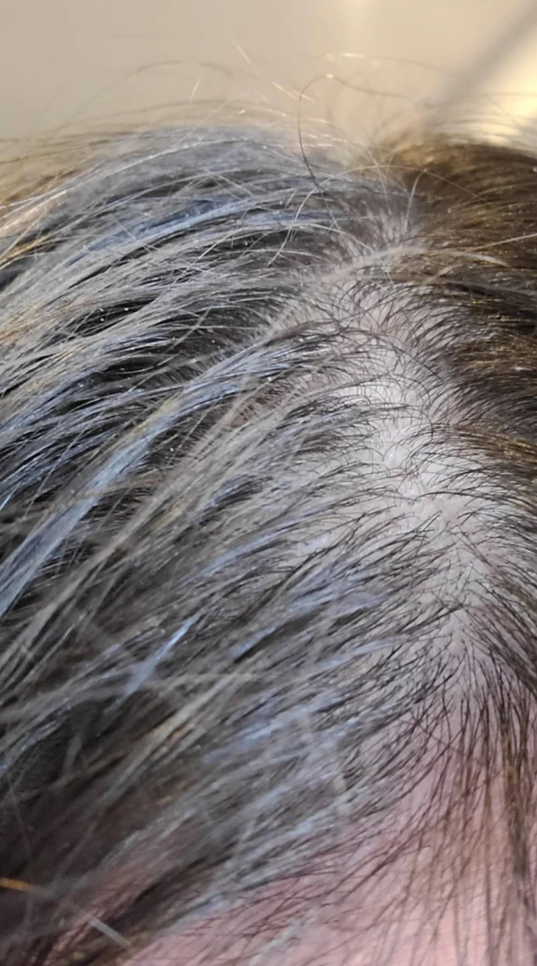 Dry Scalp During Winter: Top Remedies and Prevention Tips