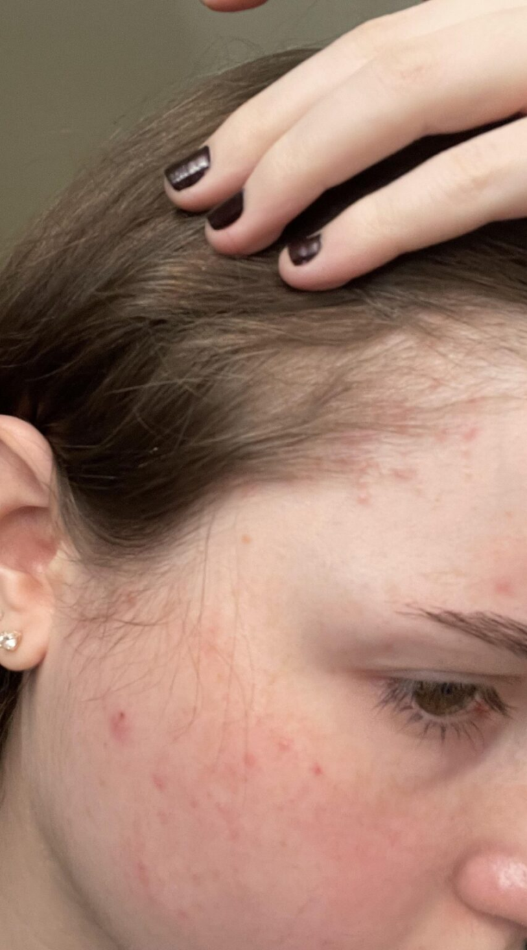 How to Get Rid of Pimples on Hairline: Clear Skin Secrets You Need to Know