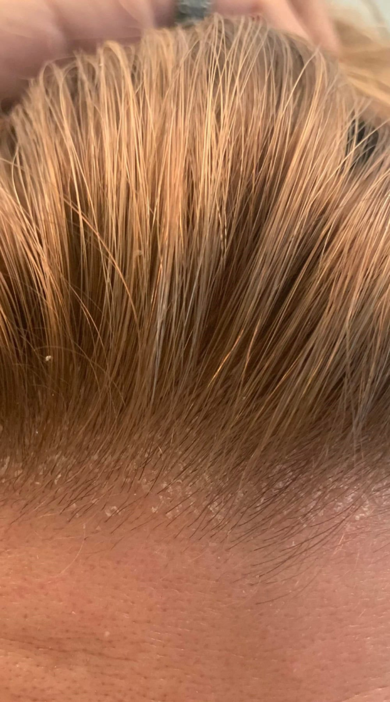 Itchy Scalp After Hair Coloring: Causes and Soothing Remedies